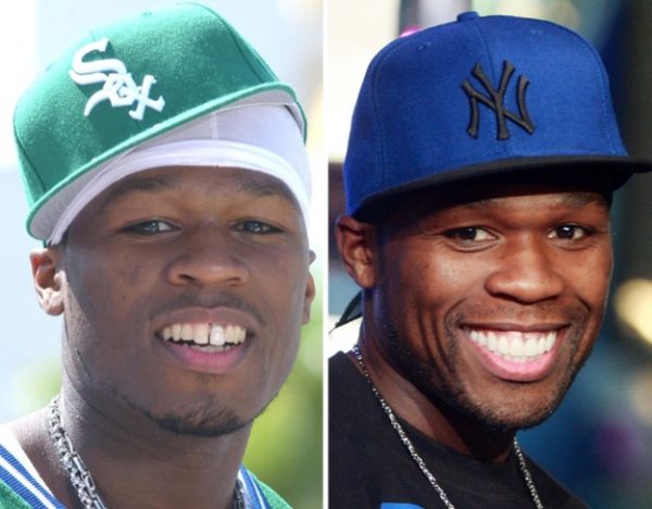 Before and after photo of Hitman Holla's teeth