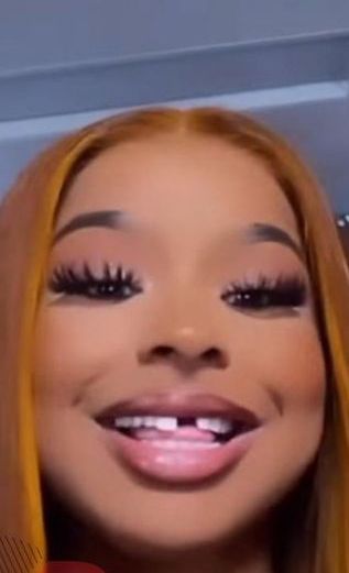 Chrisean Malone after losing her front tooth